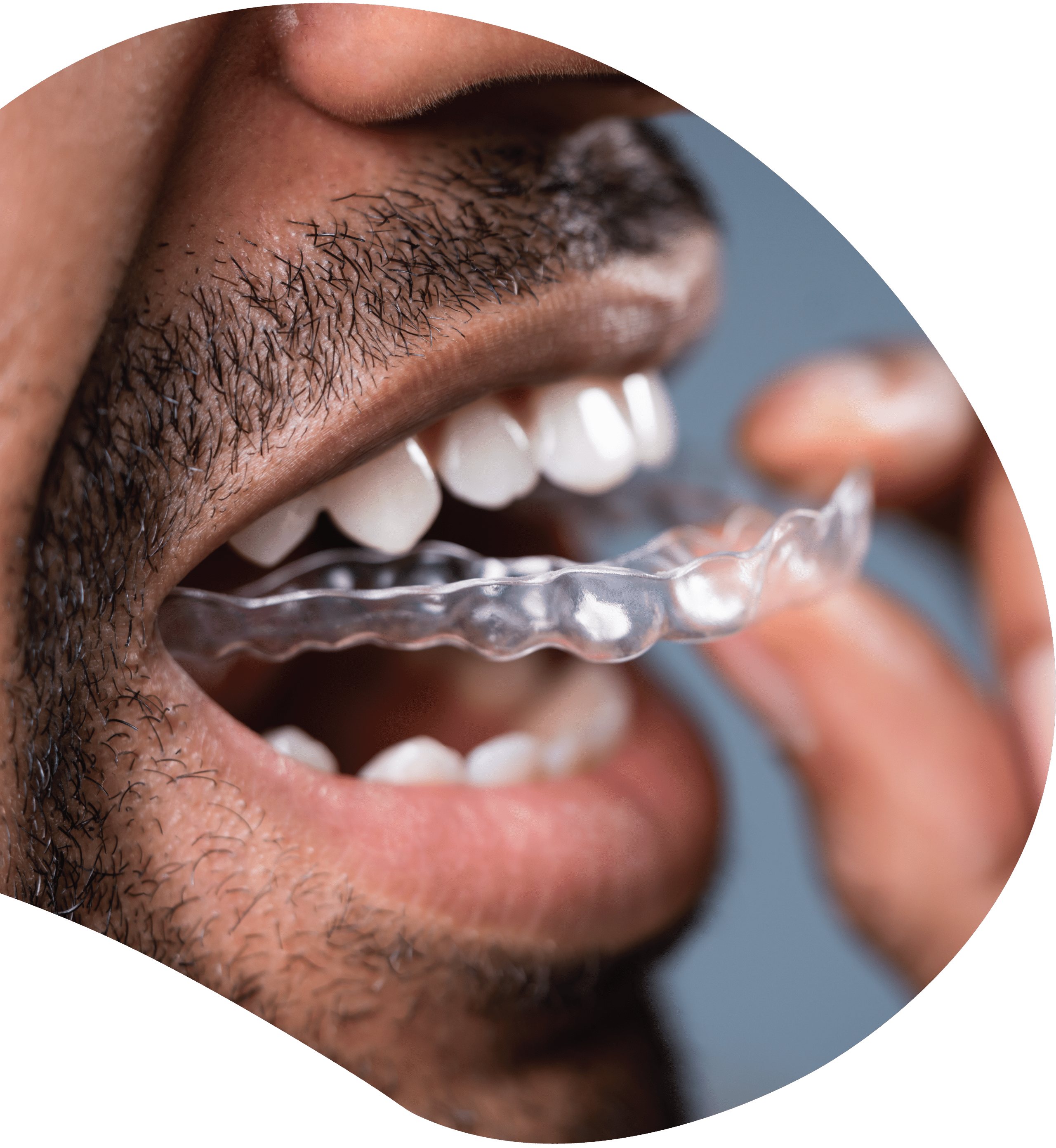 Man with facial hair putting in a clear top retainer